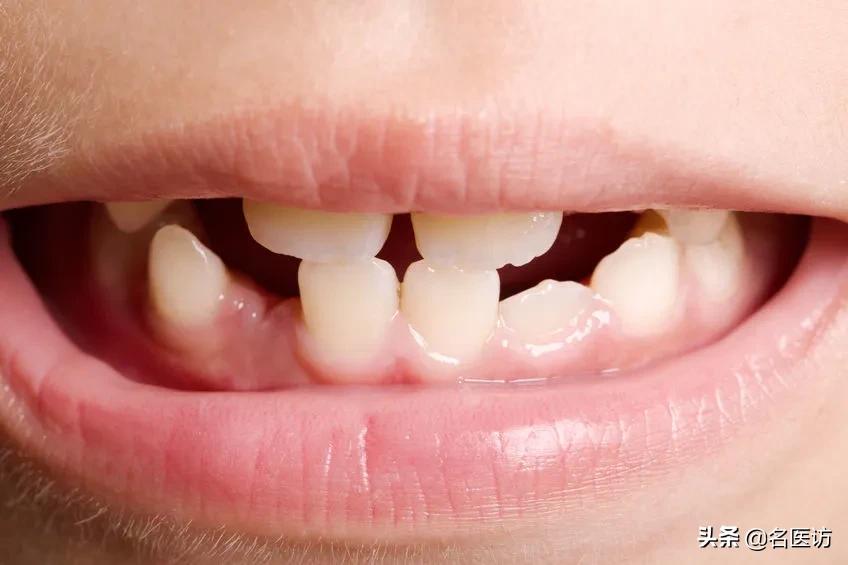 骨性地包天正畸成龅牙,地包天不拔牙正畸变龅牙