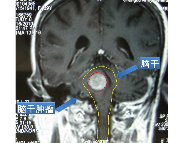 脑干肿瘤手术多少钱,脑干内部肿瘤显微手术切除