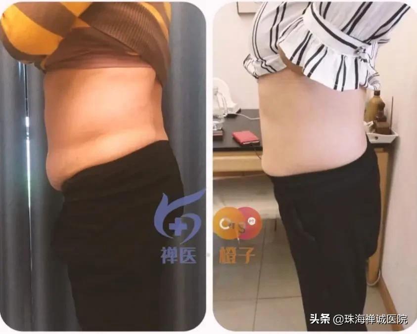 是否要做产后治疗,要不要做产后修复