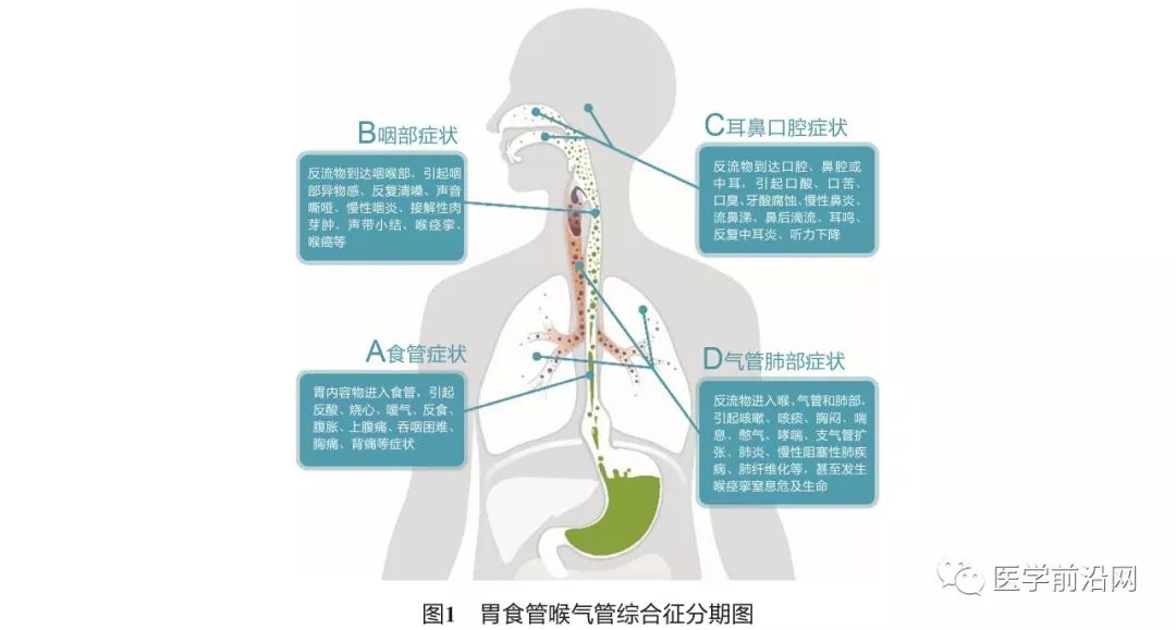 胃食管反流引起的哮喘咳嗽严重吗,胃食管反流性咽喉炎及反流性哮喘