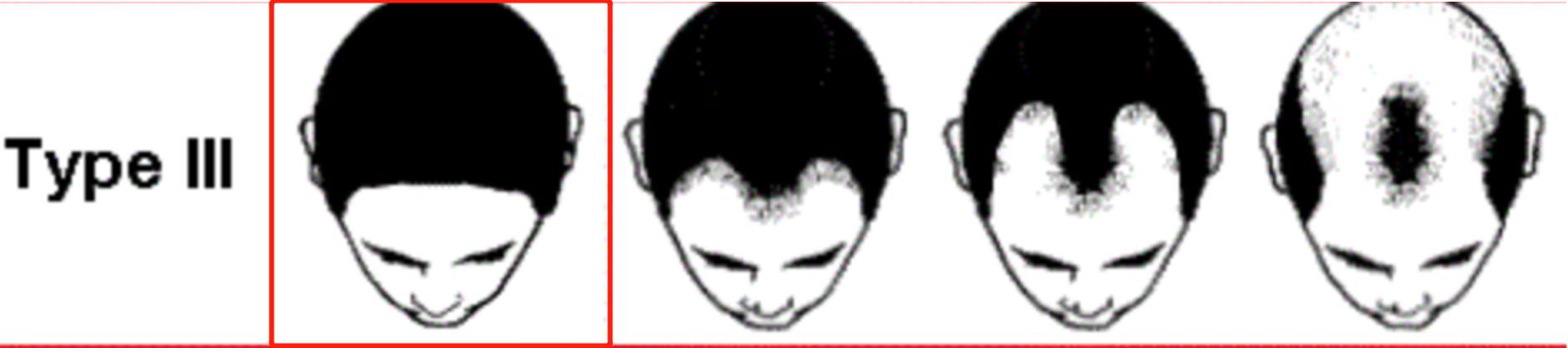 裘德洛的秃头适合什么发型,裘德洛秃顶