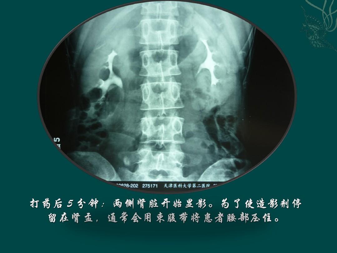 腹膜后血肿的并发症,外伤性腹膜后出血或血肿并发症
