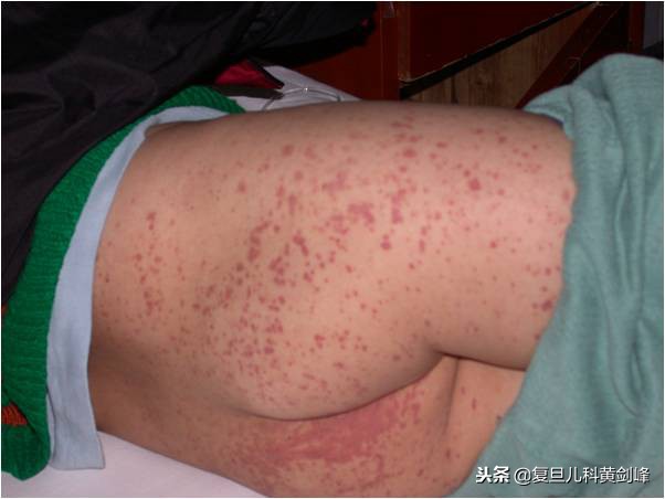 孩子腿上都是湿疹,宝宝腿上大面积皮疹