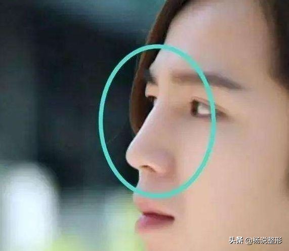 隆鼻失败的常见原因有哪些,隆鼻失败最快的解决方法