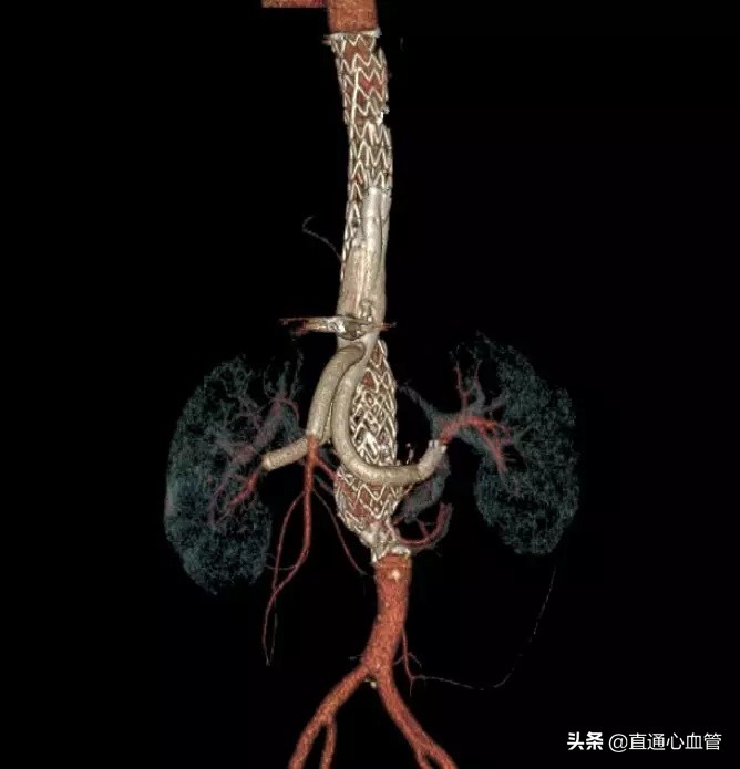 腔内“八爪鱼技术”治疗胸腹主动脉瘤！上海仁济医院血管外科叶猛团队自制“触角”完成高难度腔内隔绝术