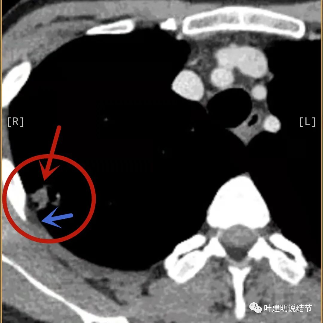 临床诊断孤立性肺结节,空洞型结节一般是什么性质