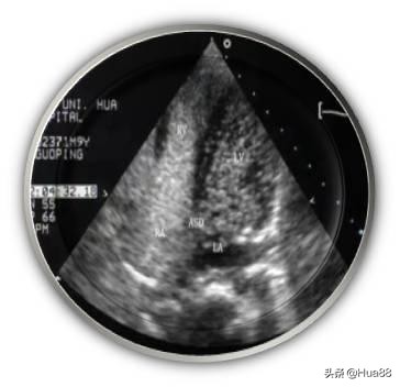 早产儿心脏卵圆孔未闭,卵圆孔未闭的原因