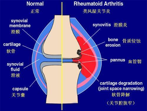 骨科膝盖积液,骨科积水怎么办