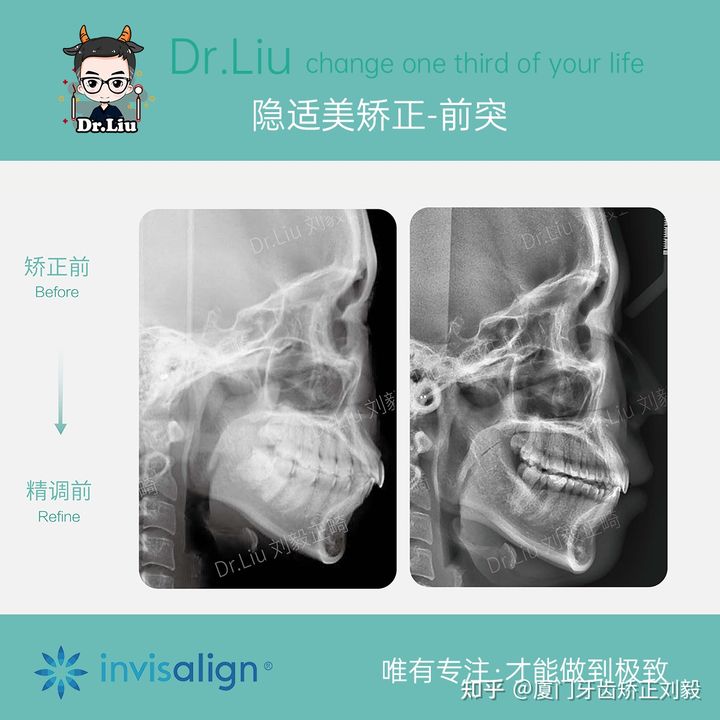 拔牙正畸矫正全过程3d,拔牙嘴凸正畸的真实案例