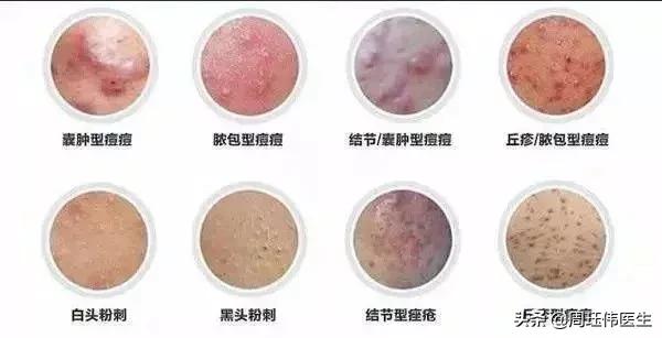 关于痘痘治疗的方法,痘痘的简单用药