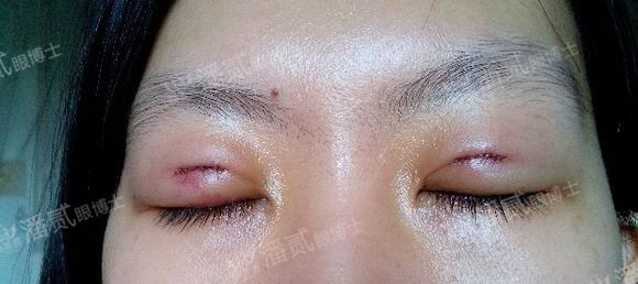 原来双眼皮不好看有必要继续割吗,割双眼皮是不是越修复越难看