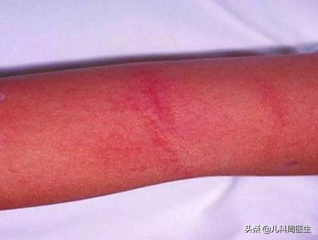 反复发热有没有可能是幼儿急疹,小孩急疹和热疹的区别