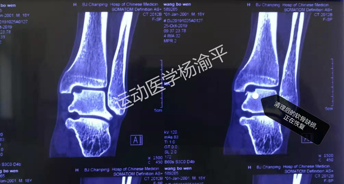 距骨软骨损伤关节镜术后关节僵硬,距骨软骨损伤关节镜手术治愈率
