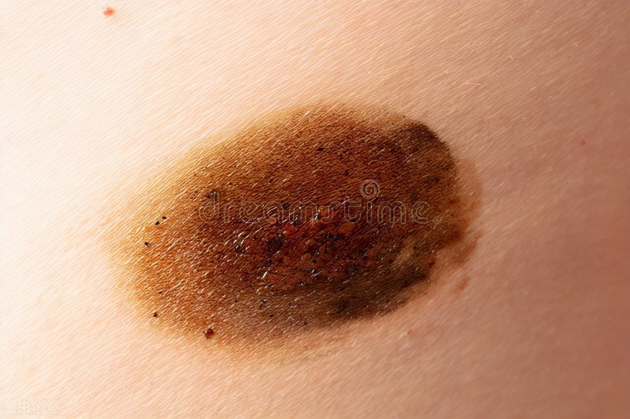 夏季虫咬皮炎怎么解决,夏季皮肤病攻略虫咬感染篇