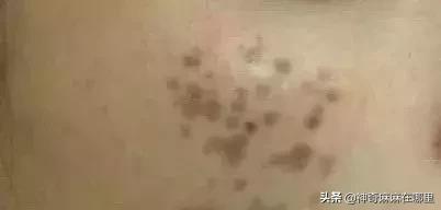 为什么用美白精华皮肤变白,为什么用了美白护肤品反而变黑了