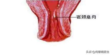 阴道出血是宫颈癌早期症状吗,宫颈癌出血多久才算严重