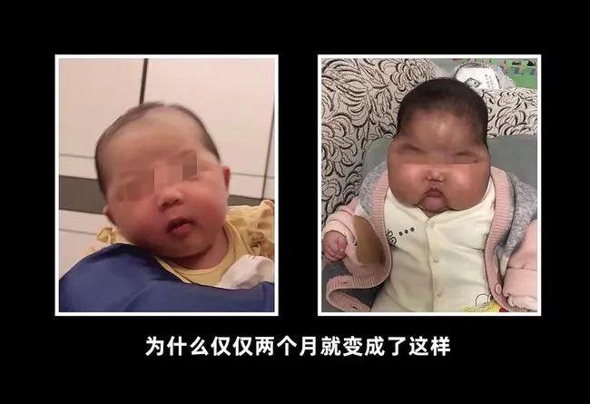 大头娃娃激素,激素大头娃娃