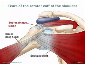 健身卧推肩膀受伤怎么恢复,卧推肩膀受限如何改善