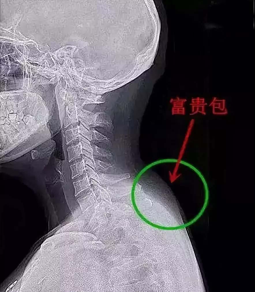 富贵包与个人的习惯,富贵包对人有什么影响吗