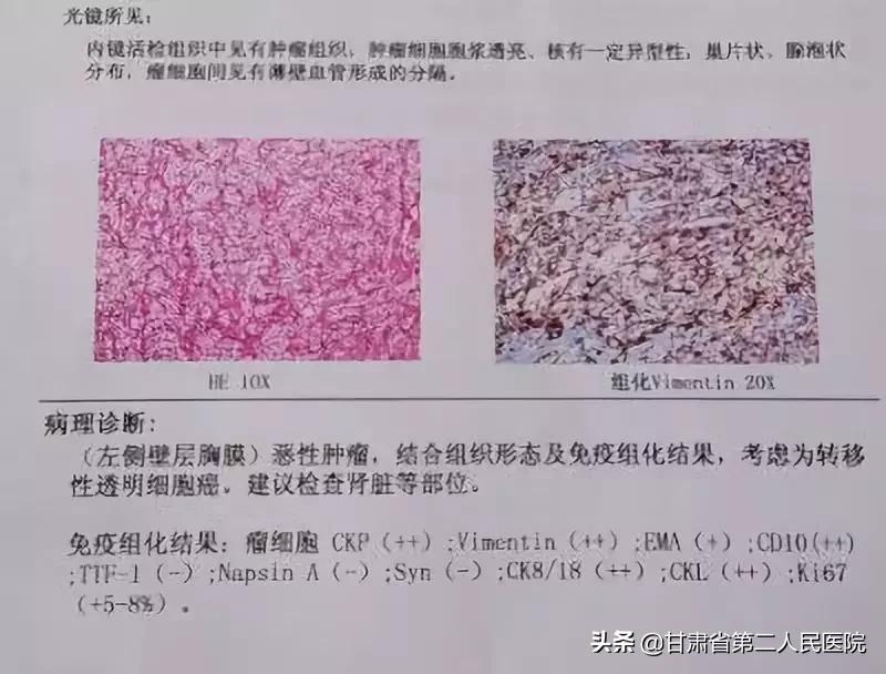 不明原因胸水怎么治,胸水患者