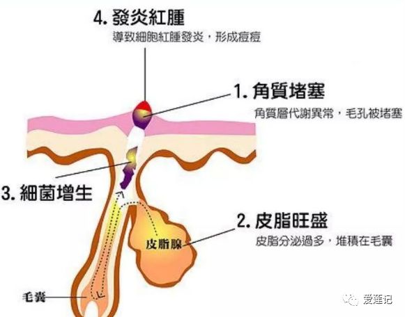 痘疮症状,战痘中的痘痘是什么