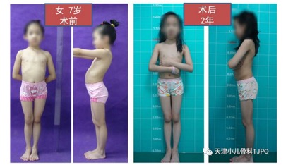 儿童髋外翻怎么治疗,儿童髋内翻是什么原因