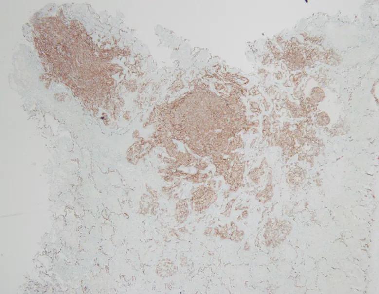 弥漫性肺泡出血是怎么回事,弥漫性肺泡出血症病因分类