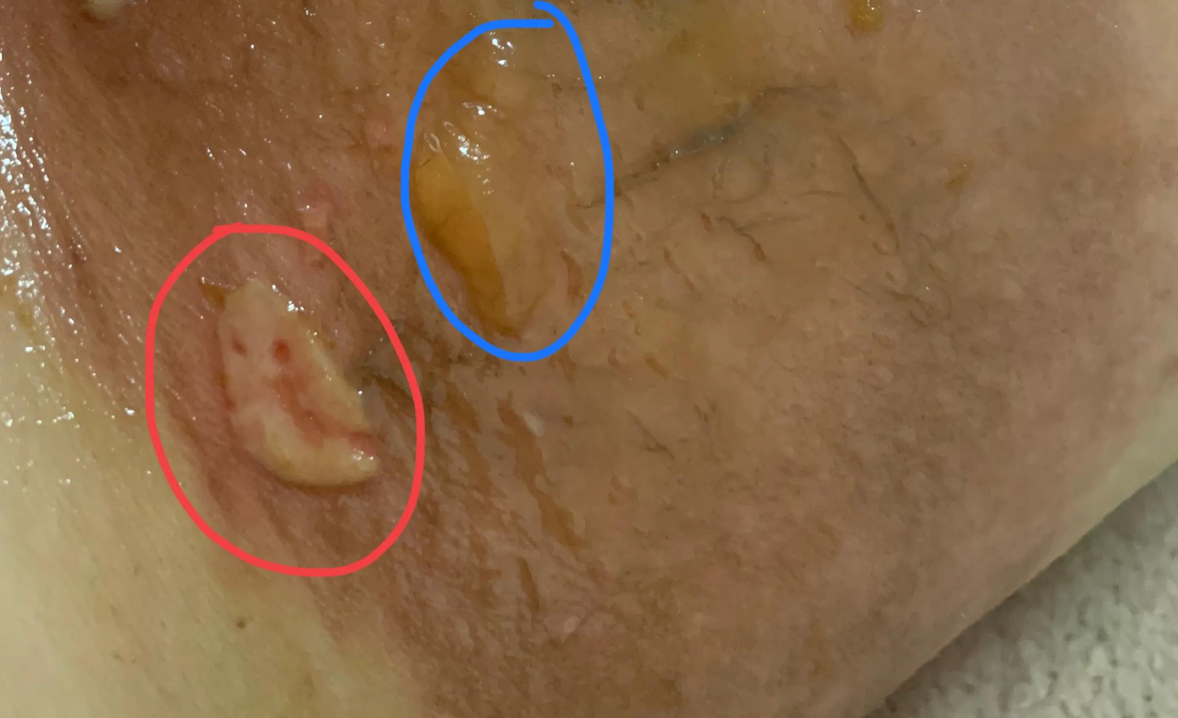 浅二度烫伤14天恢复图片,宝宝浅二度烫伤多久能恢复正常