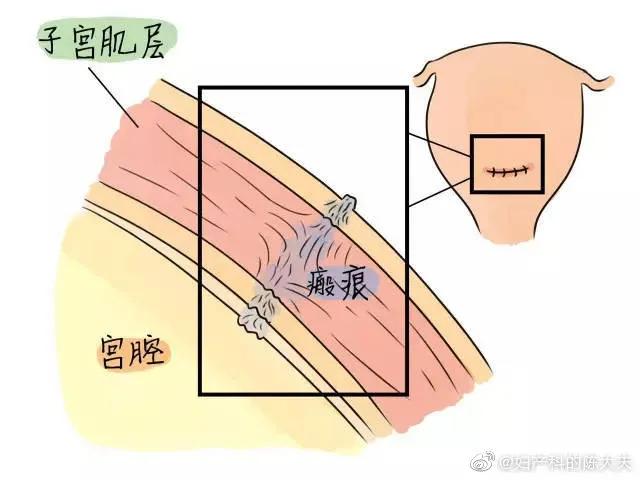 有什么合理的理由可以选择剖腹产,选择剖腹产会经历什么