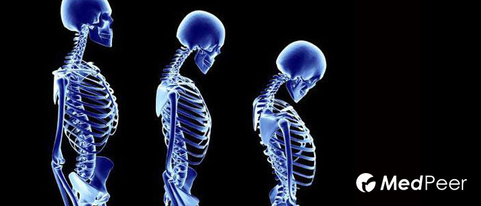 骨质疏松的药副作用,诊断为骨质疏松病人最大危险因素