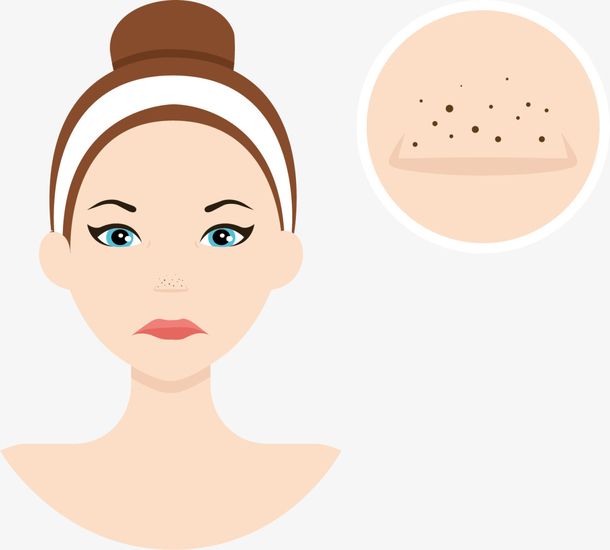 一招解决黑头的小妙招,背部黑头粉刺解决视频