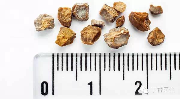 泌尿结石的排石方法,泌尿系结石综合治疗的课件