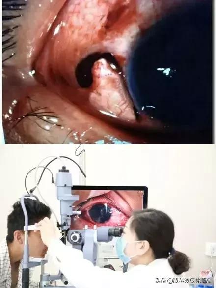 小伙被球击中眼睛,篮球砸到眼睛视力下降多久恢复