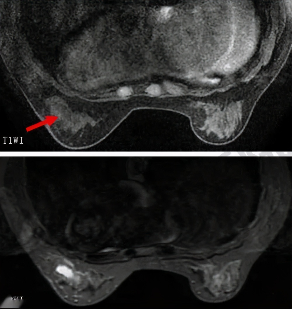 乳腺bi-rads分类有哪些,乳腺bi-rads的分类