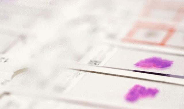 病理报告为什么这么慢,手术后病理报告准确率高吗