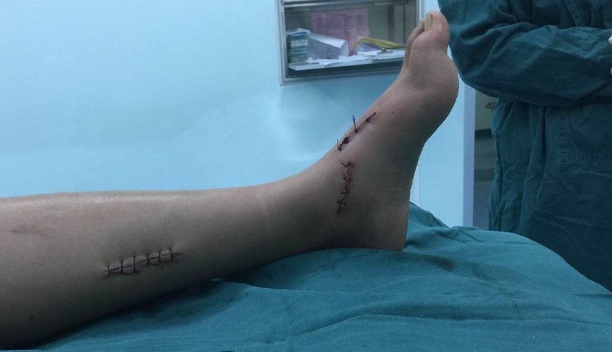 中年人扁平足做微创手术,僵硬型扁平足手术