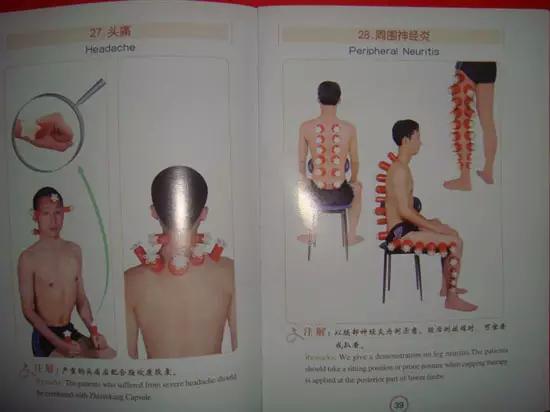 拔罐有哪些穴位图解,最全拔罐穴位疗法图解