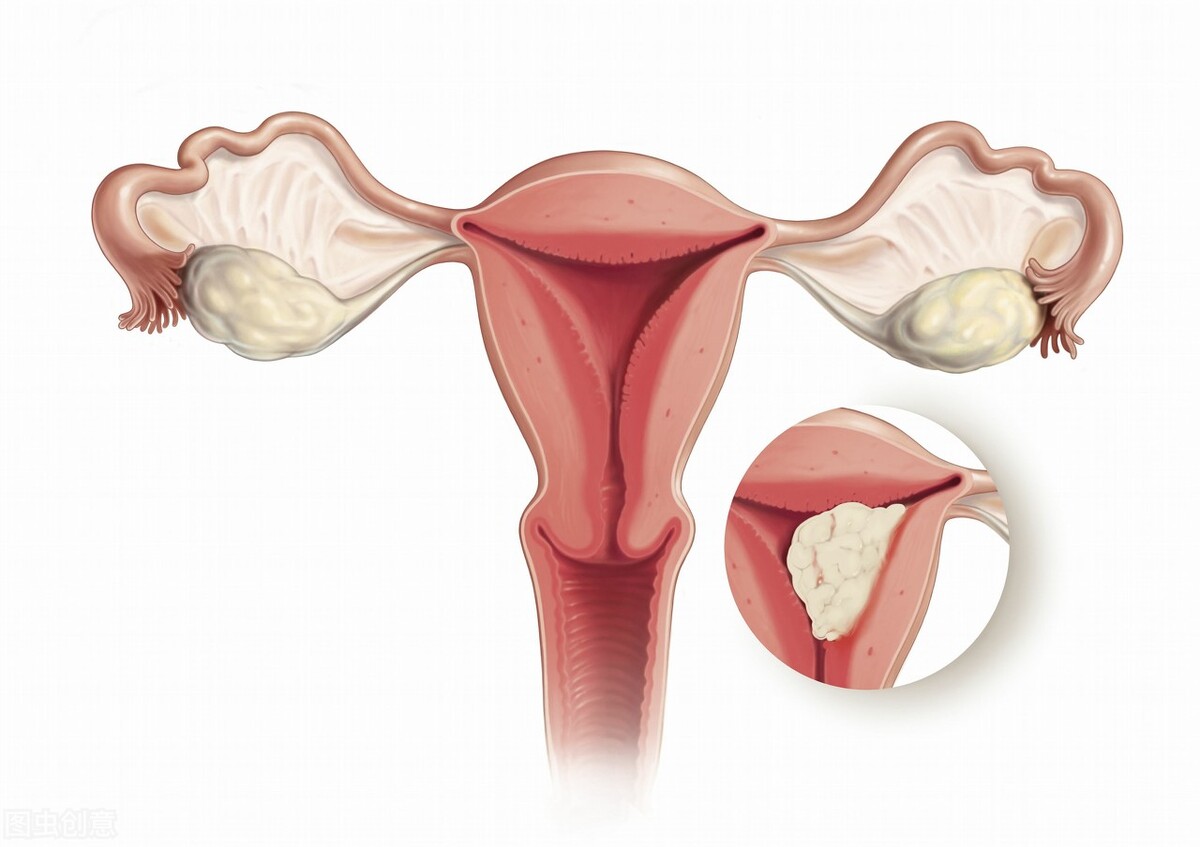哪些是子宫内膜癌的危险因素,子宫内膜癌高发人群是哪些