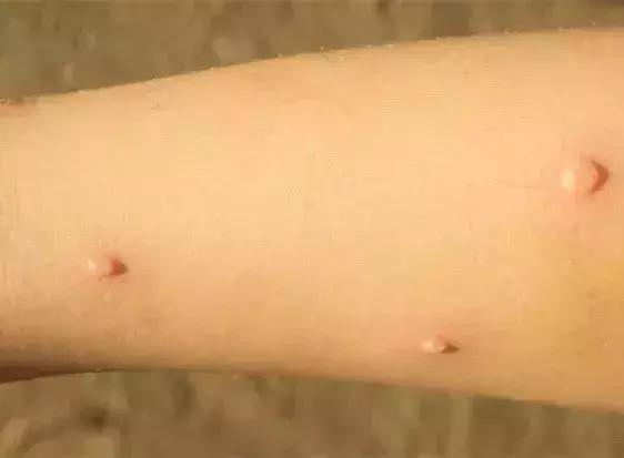 江苏最新传染病疫情消息,江苏疾控提醒6月谨防3种传染病