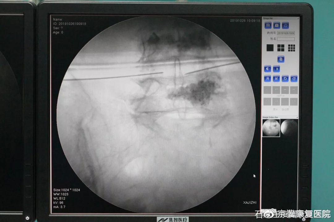 腰椎间盘突出患者无需再走弯路,亲身经历治愈腰椎间盘突出妙方