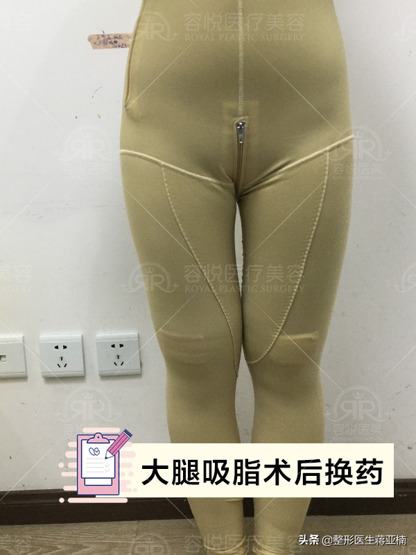 腰腹吸脂后凹凸不平多久恢复,大腿吸脂多久会出现凹凸不平