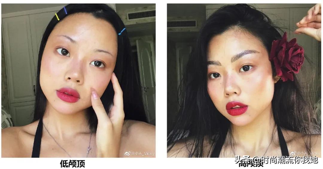 单眼皮凸嘴素人改造,肿眼泡整容成功案例