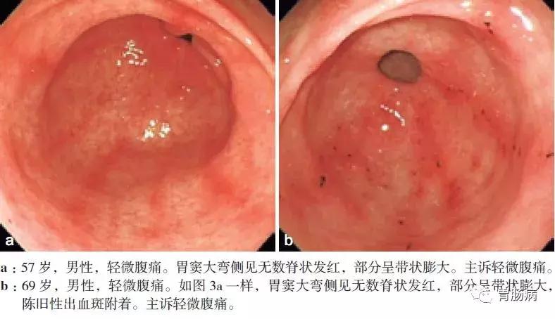 非浅表性萎缩胃炎会癌变吗,浅表性非萎缩胃炎用什么药