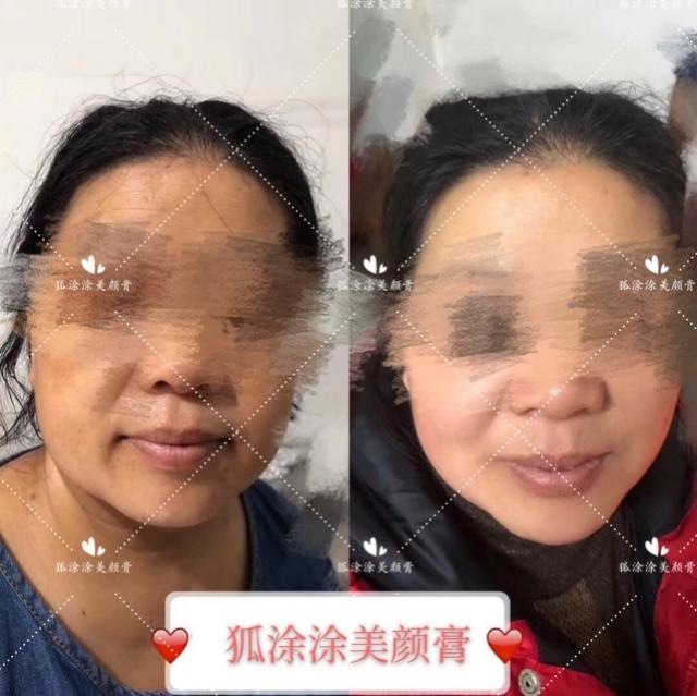 什么产品祛痘痘痘印效果好呢,祛痘印最好用的产品