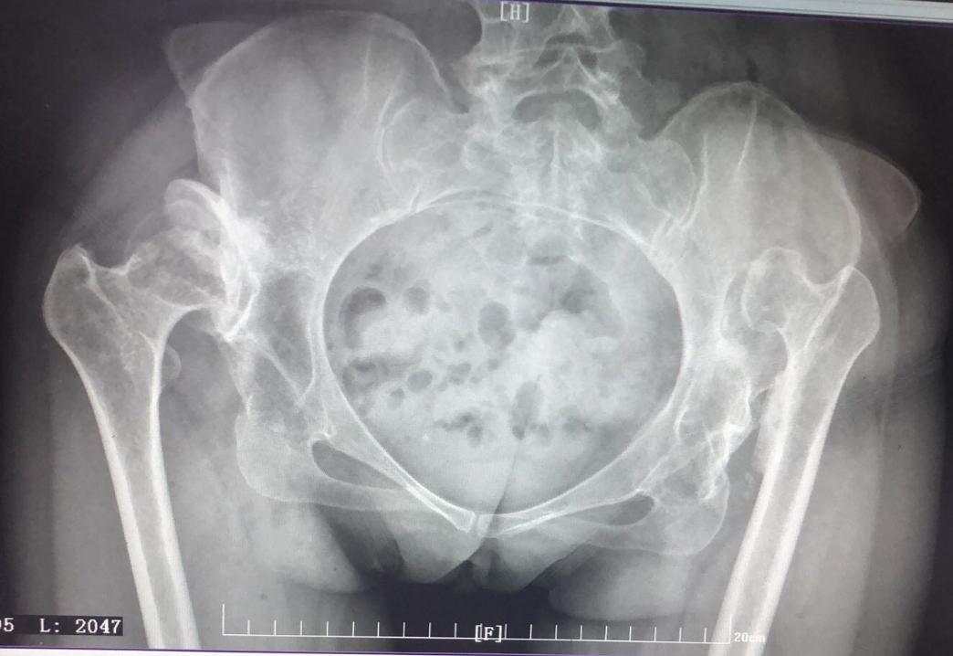 什么是成人髋关节发育不良,成人髋关节发育不良贴吧