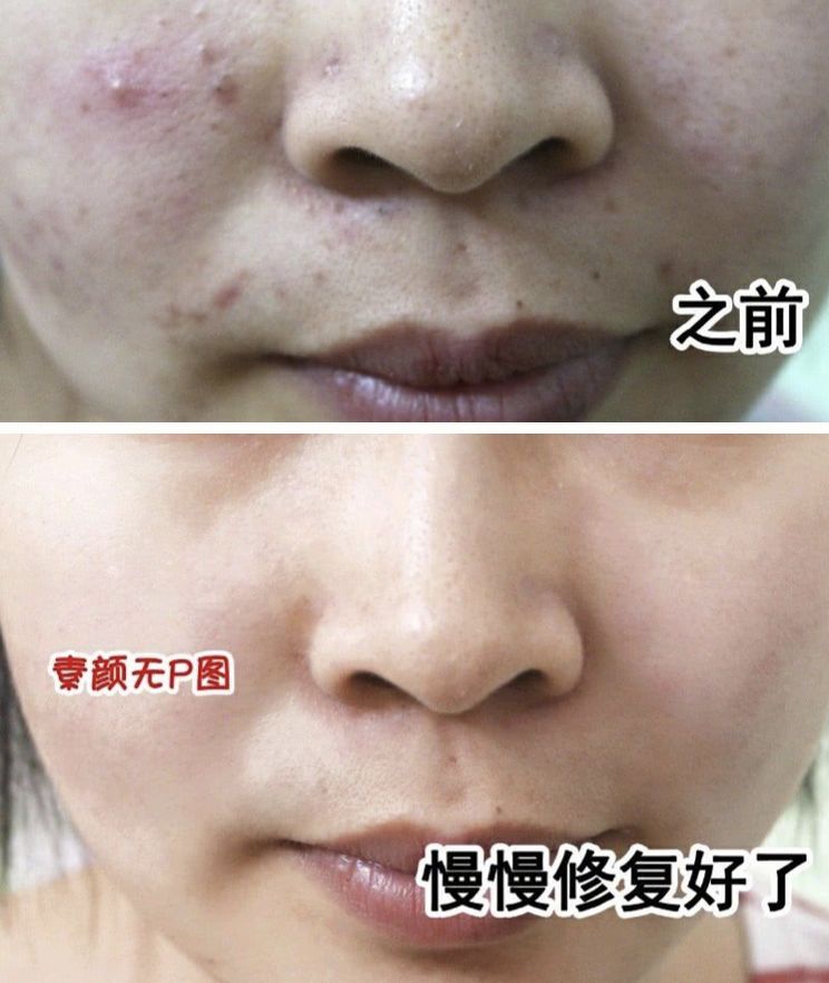 脸油痘痘多黑头用什么简单洗干净,清理黑头痘痘的最简单方法