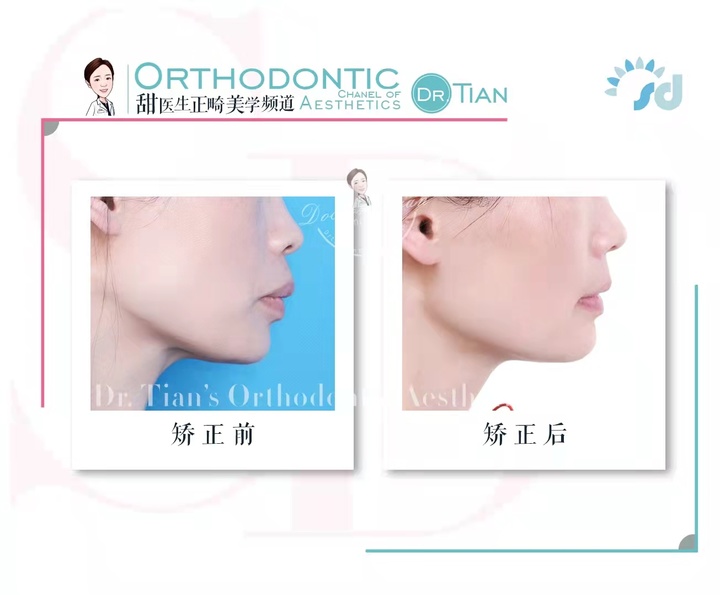 47岁大龄矫正,骨性嘴突+牙缝大+牙周炎|曹博士正畸复杂病例分享