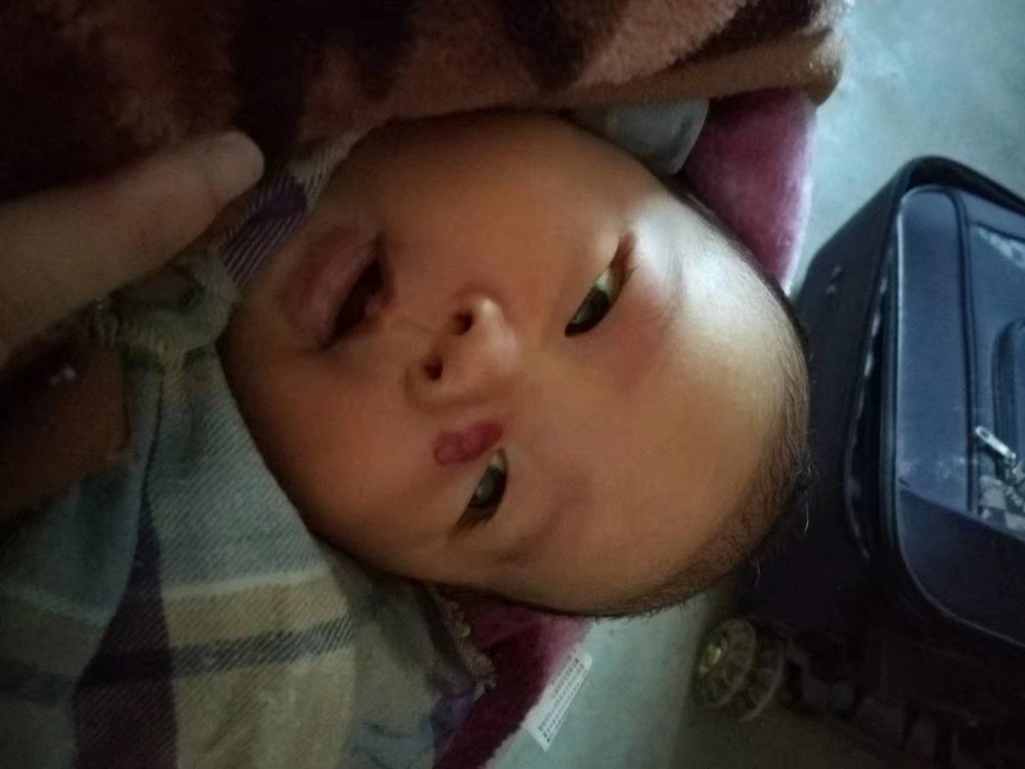 儿童血管瘤治疗成功经历,宝宝血管瘤康复过程视频