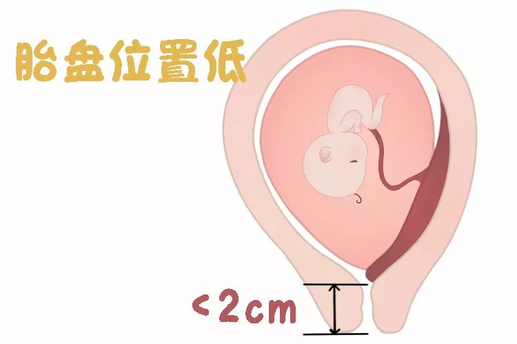 胎动异常胎儿缺氧可能性大吗,胎动异常感觉胎儿横位