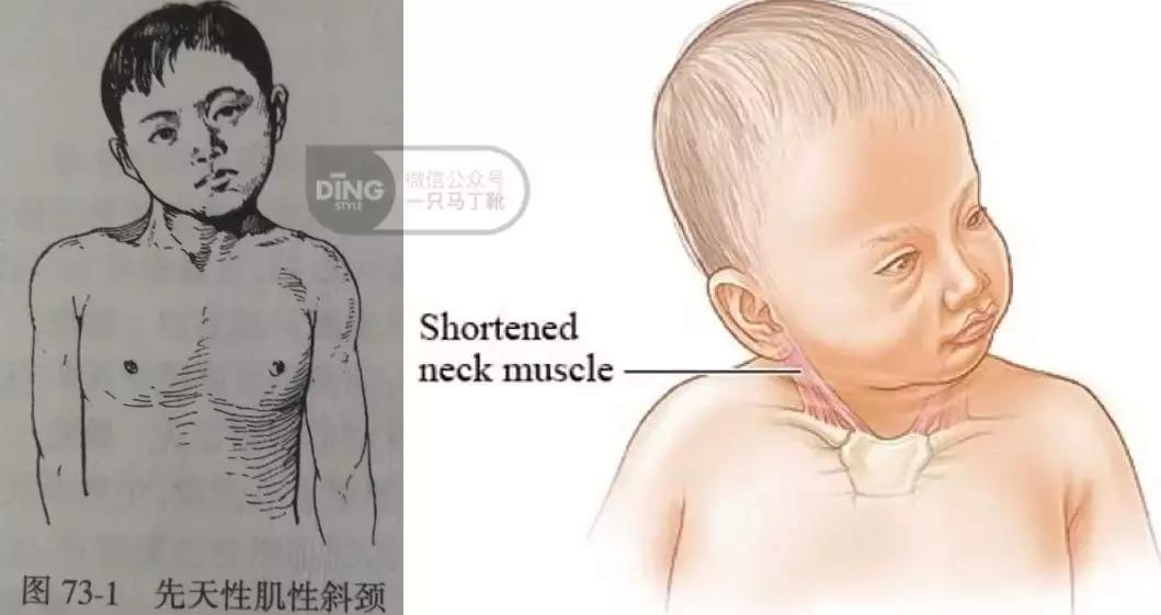 脸大小不对称怎么矫正,如何改善大小脸不对称